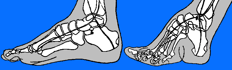 Deformazione della fasciatura del piede
