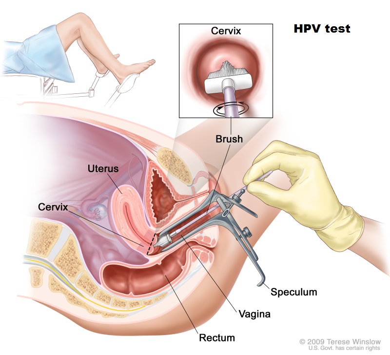 Come avviene il prelievo per il Pap test e l'HPV test