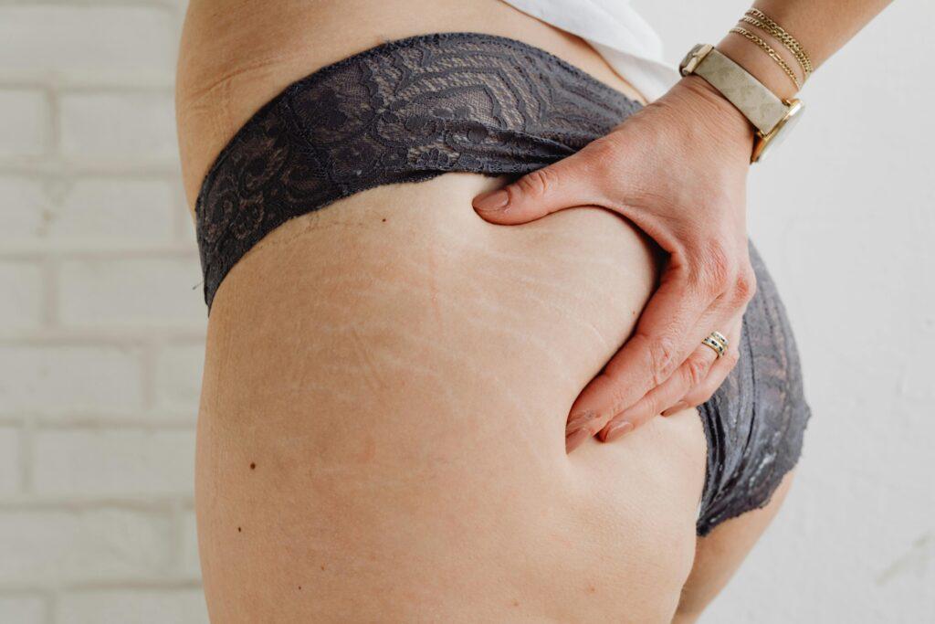 Smagliature sui glutei