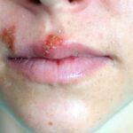 Herpes labialis