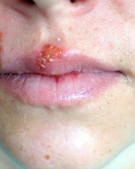 Herpes labialis