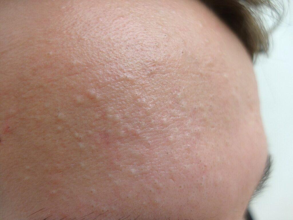 Acne vulgaris di tipo comedonico.