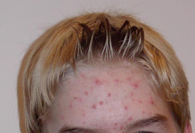 Acne vulgaris, di tipo papulo-pustoloso. Immagine di pubblico dominio.