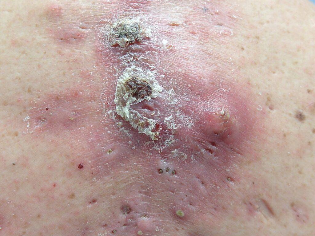 Acne conglobata.