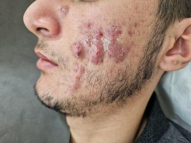 Acne nodulo-cistica.