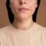 Viso di donna con lesioni acneiche.