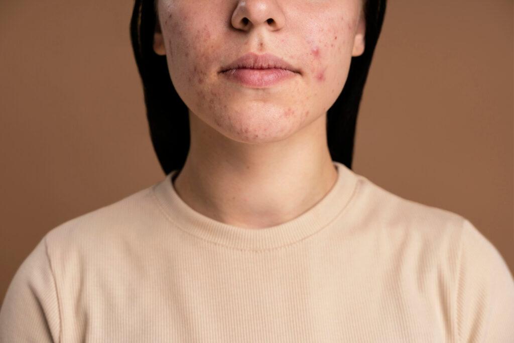 Viso di donna con lesioni acneiche.