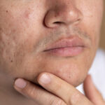 Cicatrici da acne. Image by freepik
