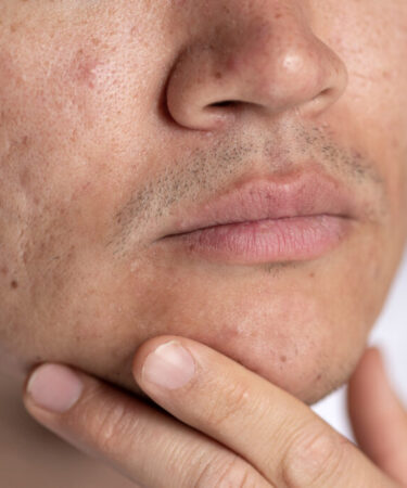 Cicatrici da acne. Image by freepik