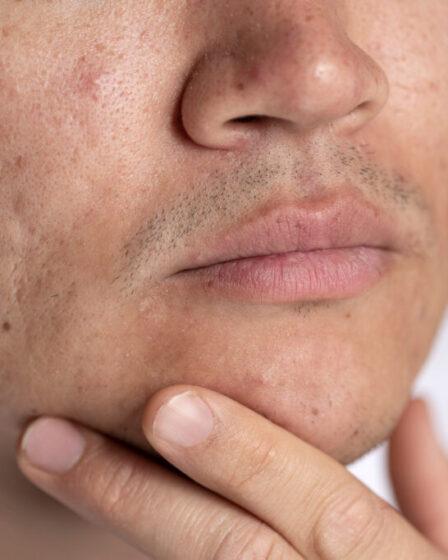 Cicatrici da acne. Image by freepik