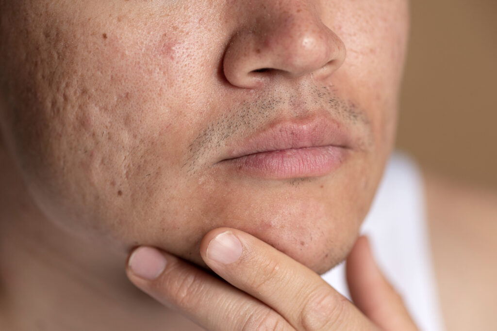 Cicatrici da acne. Image by freepik
