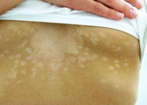 Il lievito Malassezia causa le macchie bianche tipiche della pitiriasi versicolor producendo acido azelaico e altri metaboliti con attività antitirosinasi. Immagine presa da Wikimedia Commons (crediti nell'articolo).
